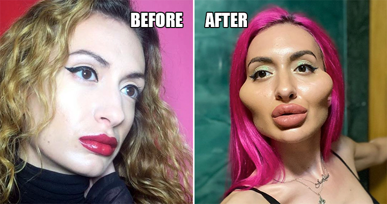 Instagram Influencer Gets Giant Cheekbones After Injecting Her Face